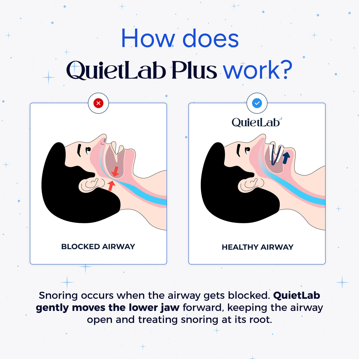 Getquietlab Plus® Anti-Snoring Mouthpiece